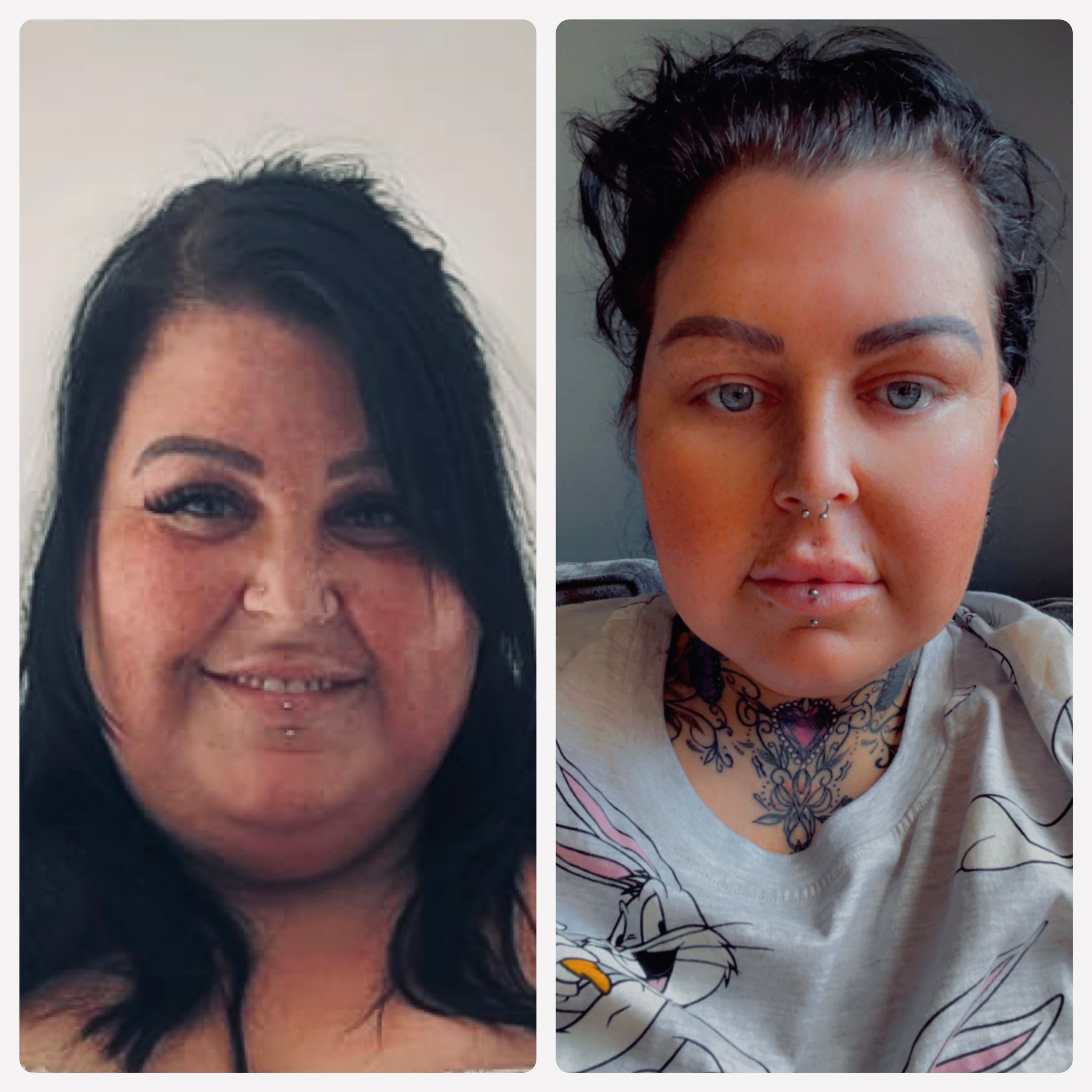 gastric sleeve in turkey